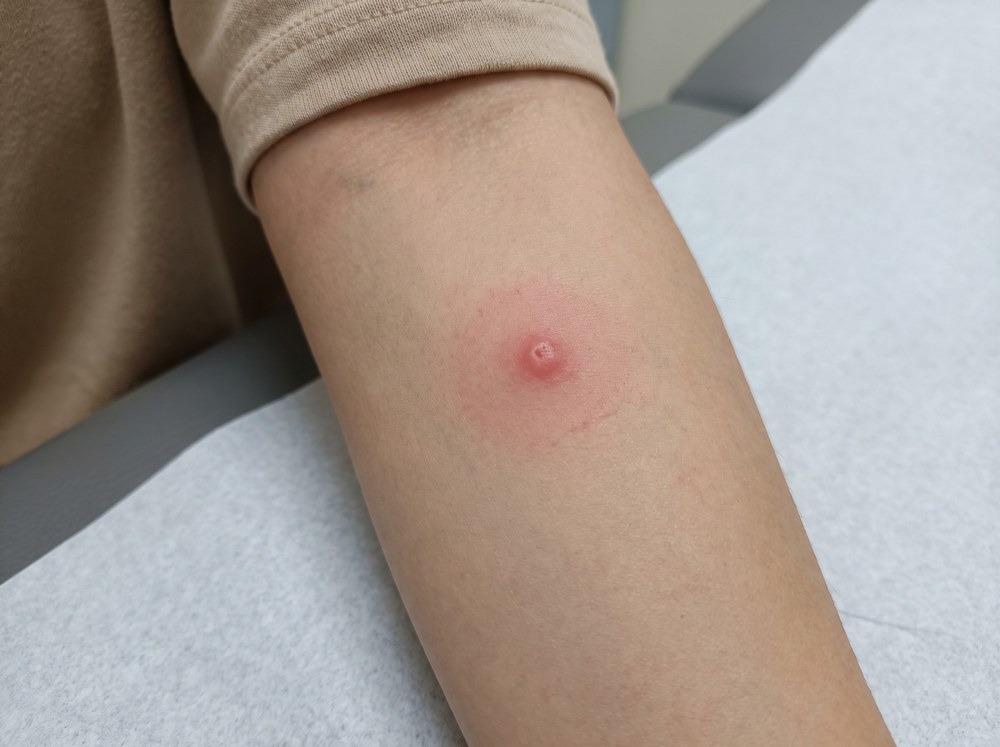Close-up photo of a small red itchy skin welt about one inch across with no blistering, puncture pattern, or dark center